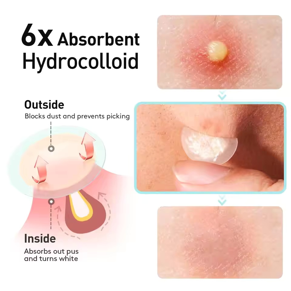 360枚/箱 ニキビパッチ - アルコールフリー、ニキビの分 - Face Oil のレビューと価格